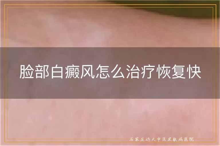 脸部白癜风怎么治疗恢复快