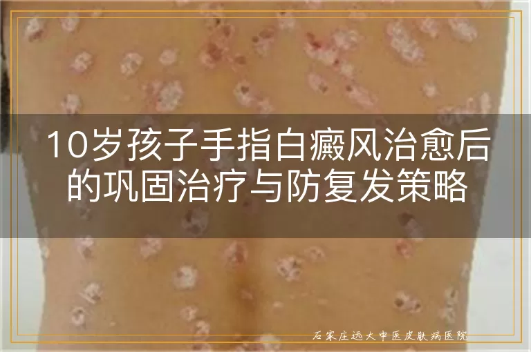 10岁孩子手指白癜风治愈后的巩固治疗与防复发策略