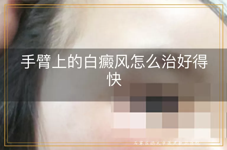 手臂上的白癜风怎么治好得快