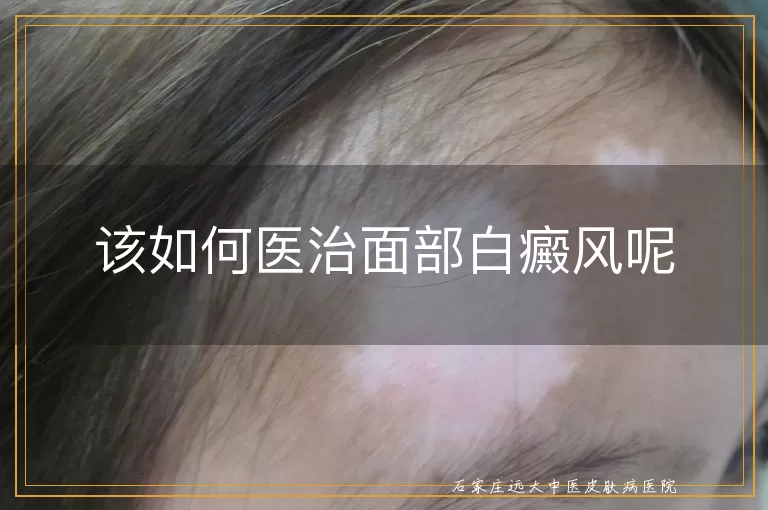 该如何医治面部白癜风呢