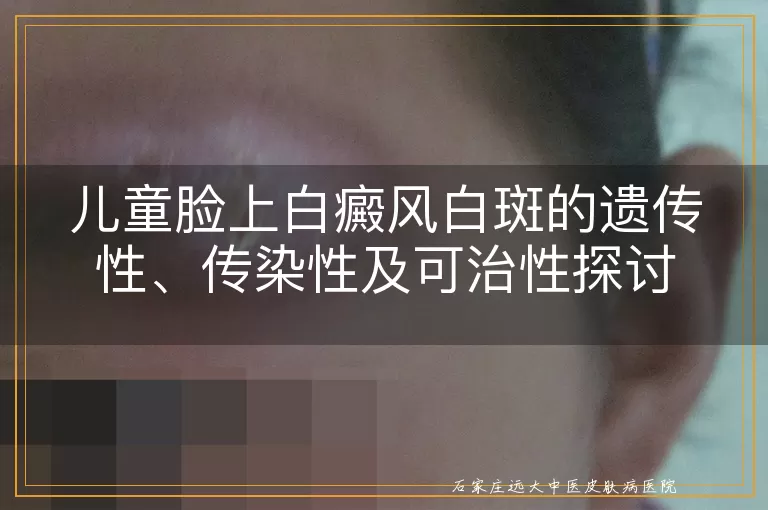 儿童脸上白癜风白斑的遗传性、传染性及可治性探讨