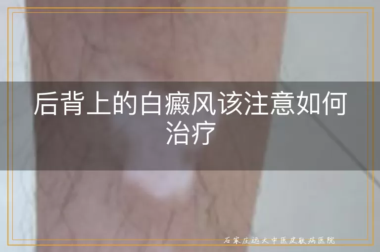后背上的白癜风该注意如何治疗