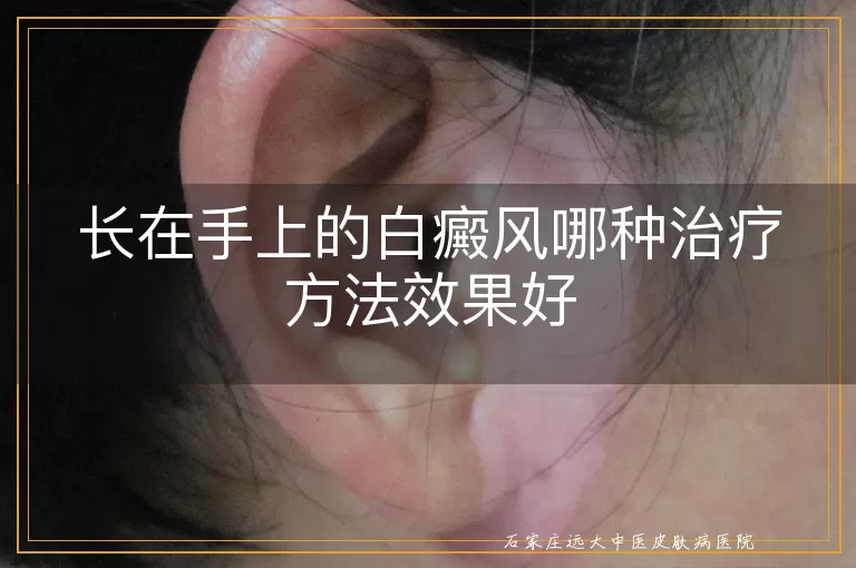 长在手上的白癜风哪种治疗方法效果好
