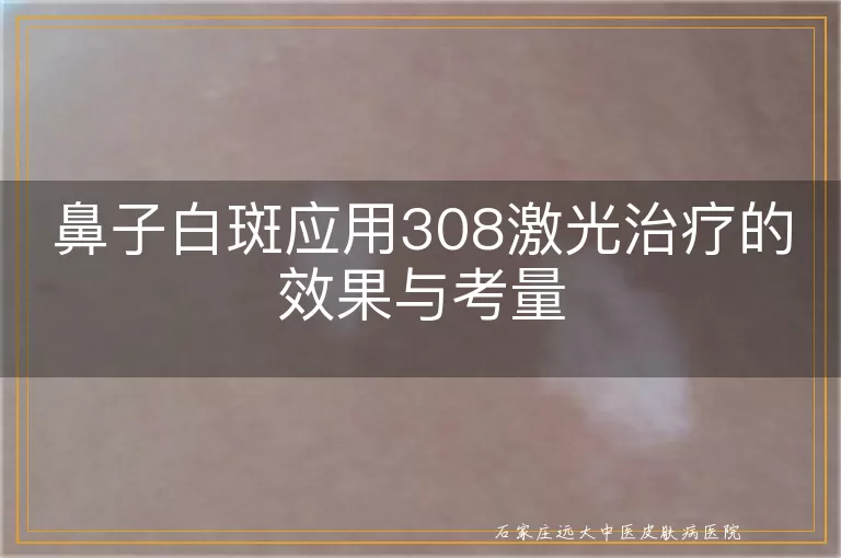 鼻子白斑应用308激光治疗的效果与考量