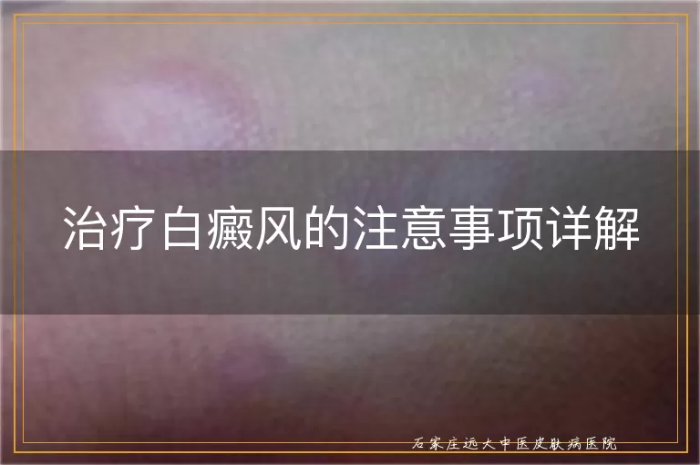 治疗白癜风的注意事项详解