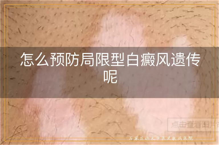 怎么预防局限型白癜风遗传呢