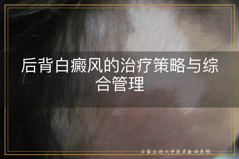 后背白癜风的治疗策略与综合管理