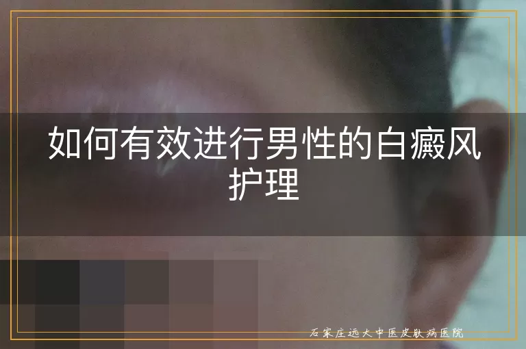 如何有效进行男性的白癜风护理