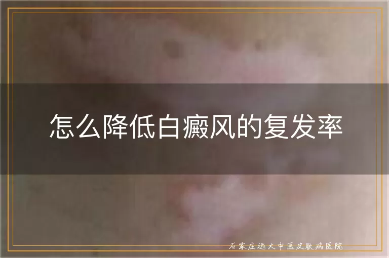 怎么降低白癜风的复发率