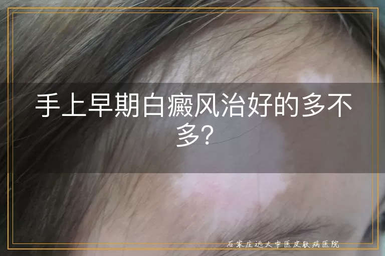 手上早期白癜风治好的多不多？