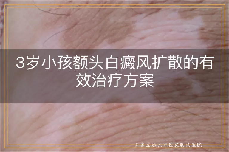 3岁小孩额头白癜风扩散的有效治疗方案