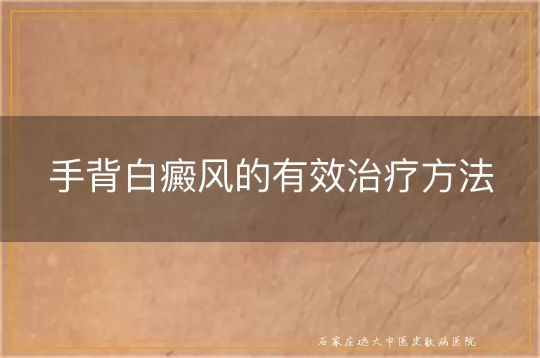 手背白癜风的有效治疗方法
