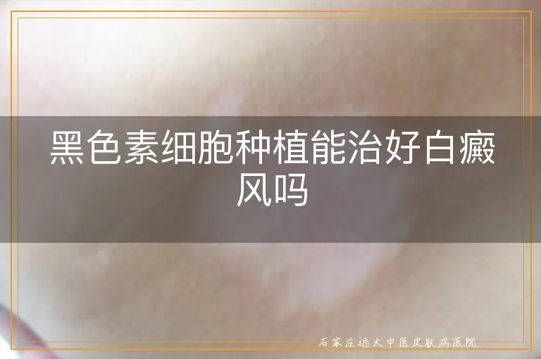黑色素细胞种植能治好白癜风吗