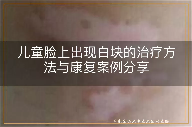 儿童脸上出现白块的治疗方法与康复案例分享