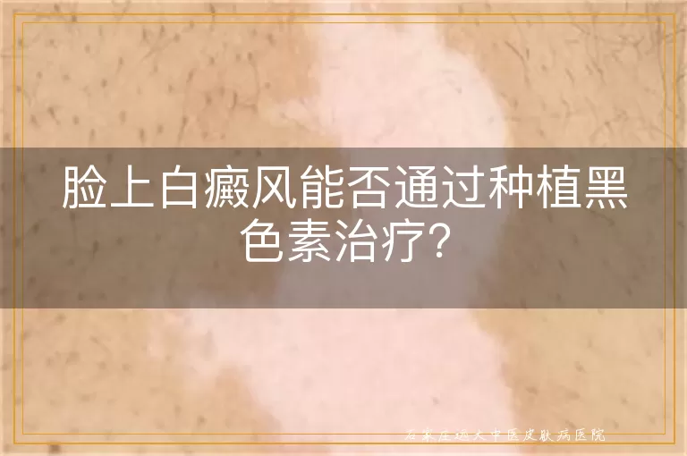 脸上白癜风能否通过种植黑色素治疗？
