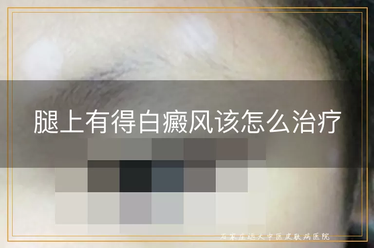 腿上有得白癜风该怎么治疗