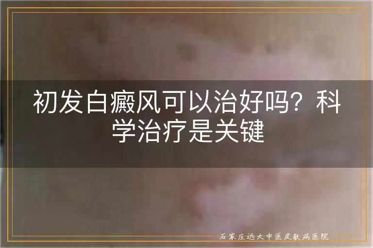 初发白癜风可以治好吗？科学治疗是关键