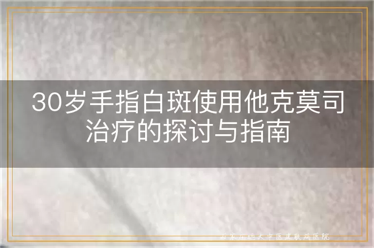 30岁手指白斑使用他克莫司治疗的探讨与指南