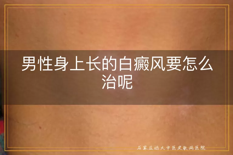 男性身上长的白癜风要怎么治呢