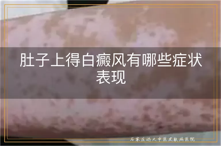 肚子上得白癜风有哪些症状表现