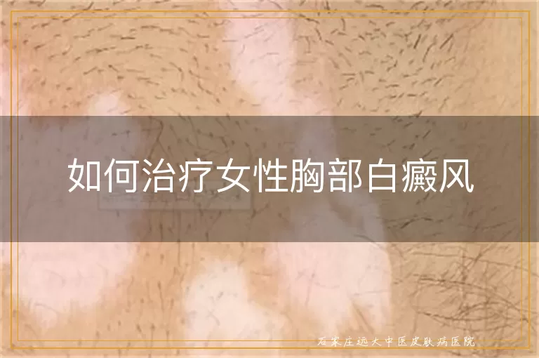 如何治疗女性胸部白癜风