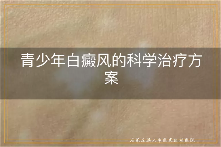 青少年白癜风的科学治疗方案