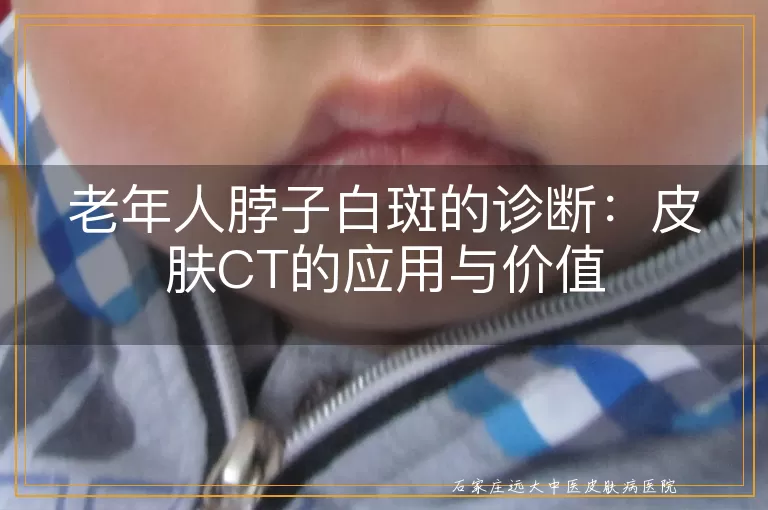 老年人脖子白斑的诊断：皮肤CT的应用与价值