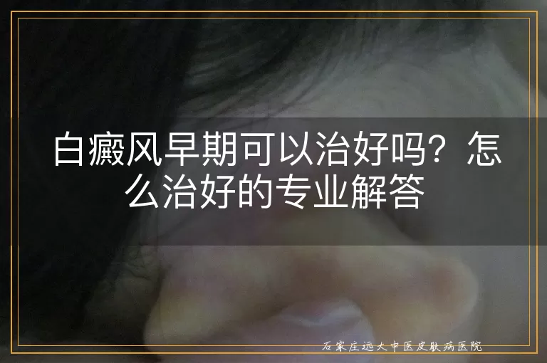 白癜风早期可以治好吗？怎么治好的专业解答