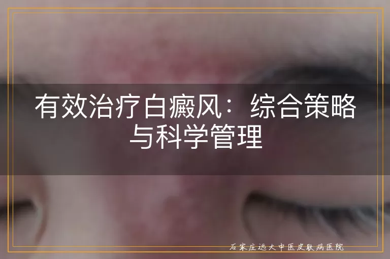 有效治疗白癜风：综合策略与科学管理