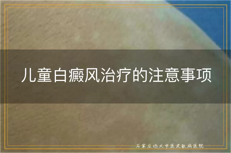 儿童白癜风治疗的注意事项