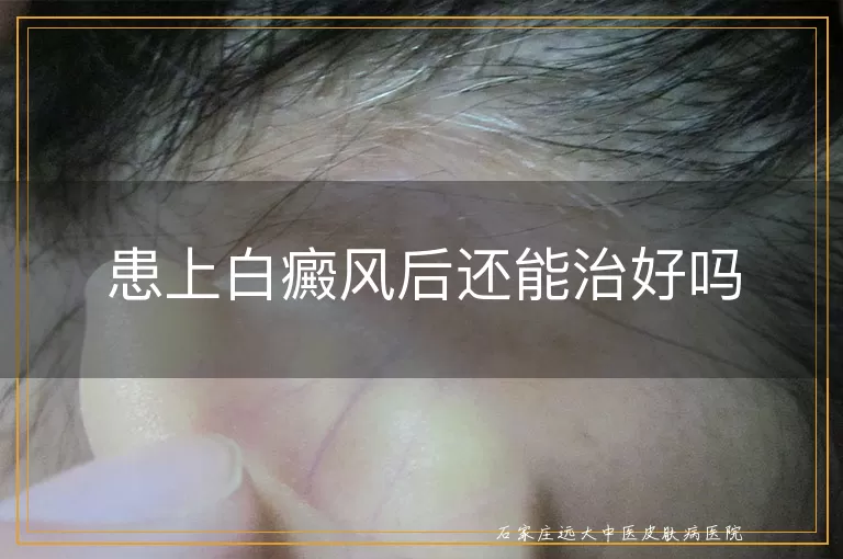 患上白癜风后还能治好吗