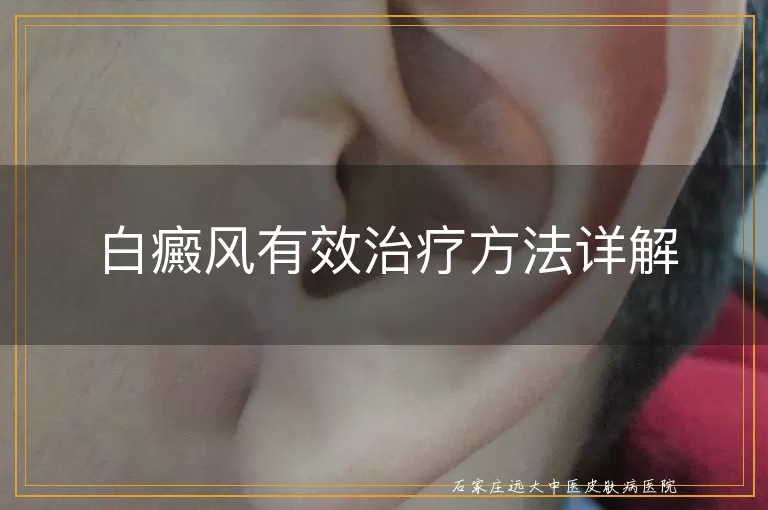 白癜风有效治疗方法详解