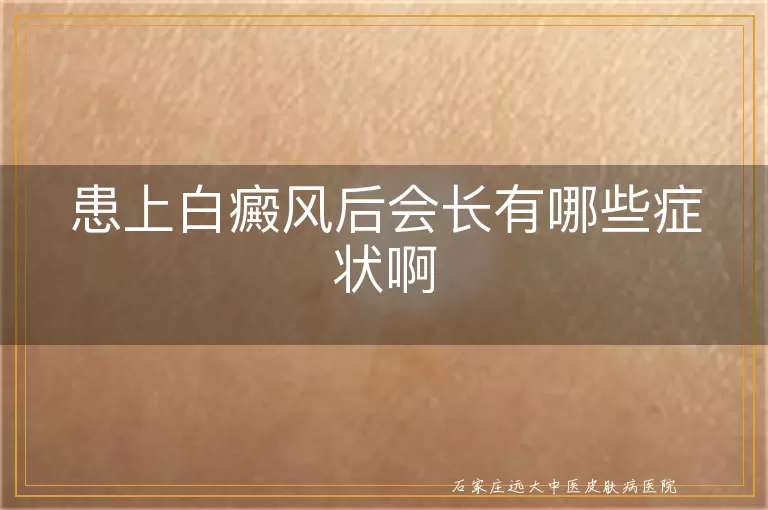 患上白癜风后会长有哪些症状啊