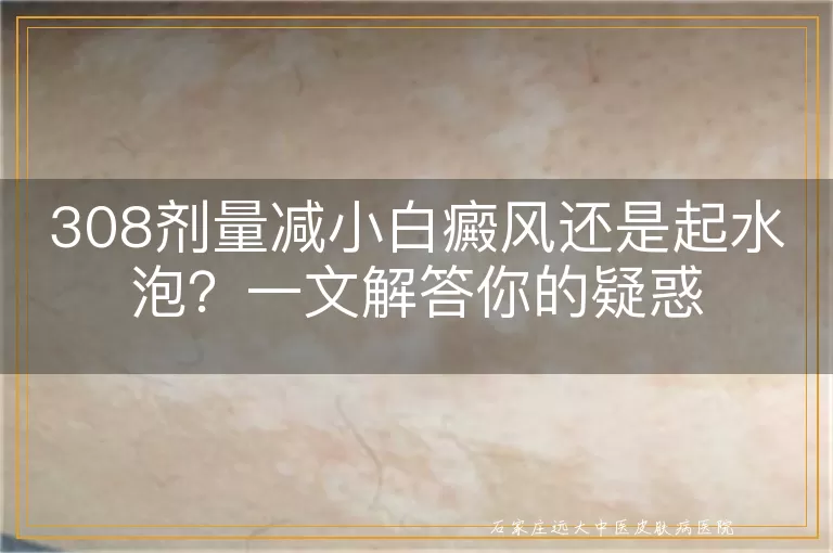 308剂量减小白癜风还是起水泡？一文解答你的疑惑
