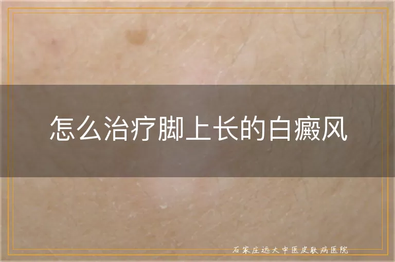 怎么治疗脚上长的白癜风