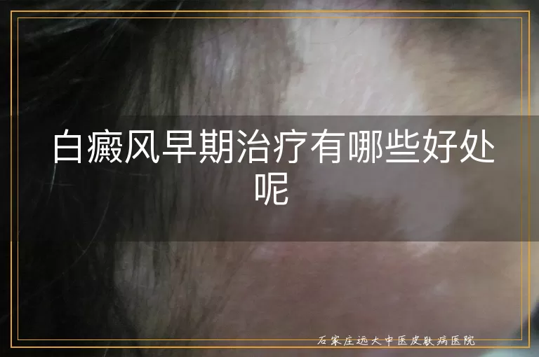 白癜风早期治疗有哪些好处呢