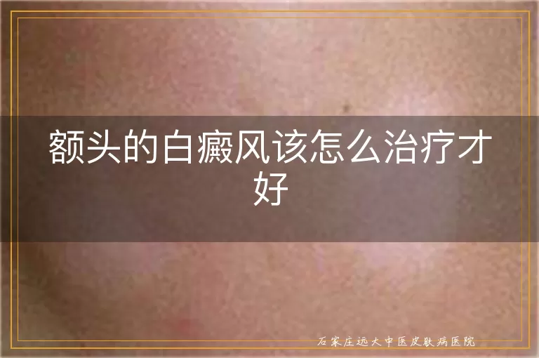 额头的白癜风该怎么治疗才好