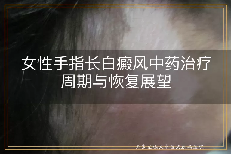 女性手指长白癜风中药治疗周期与恢复展望