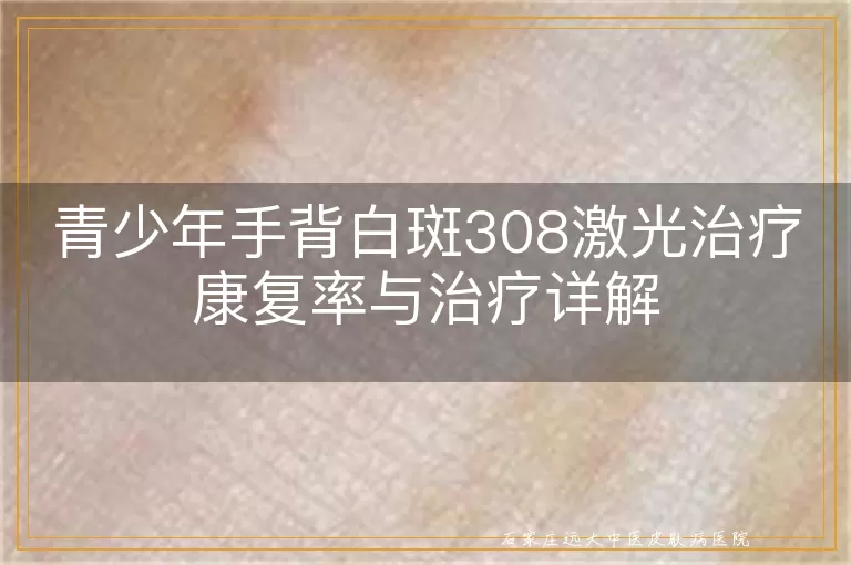 青少年手背白斑308激光治疗康复率与治疗详解
