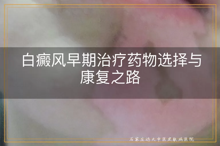 白癜风早期治疗药物选择与康复之路