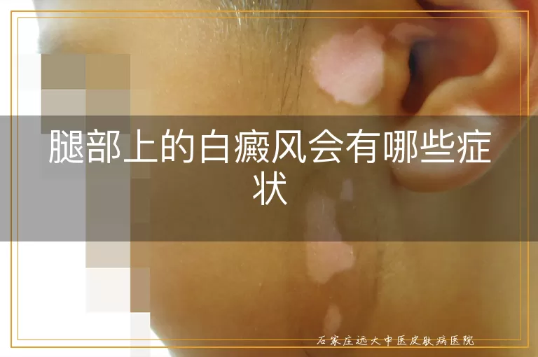 腿部上的白癜风会有哪些症状