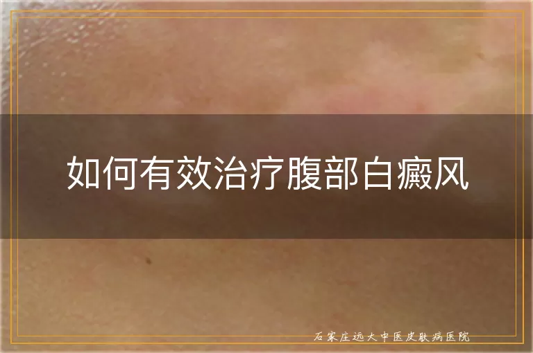如何有效治疗腹部白癜风