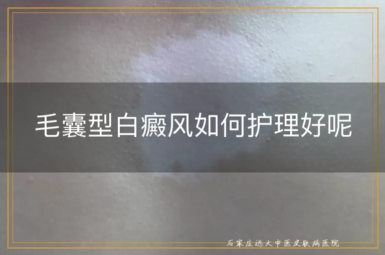毛囊型白癜风如何护理好呢