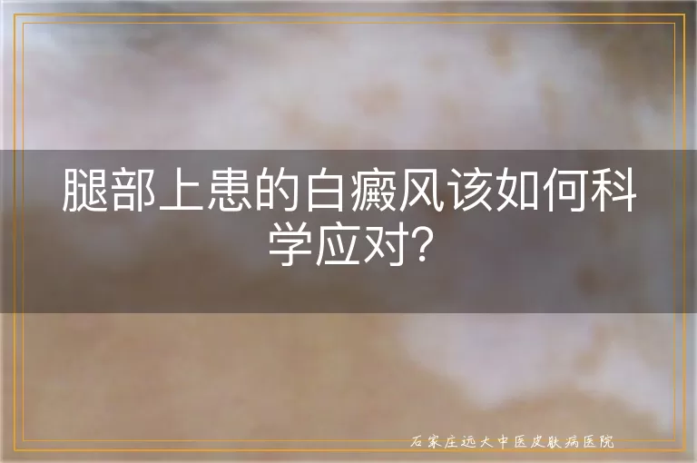 腿部上患的白癜风该如何科学应对？