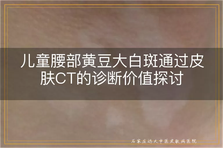 儿童腰部黄豆大白斑通过皮肤CT的诊断价值探讨