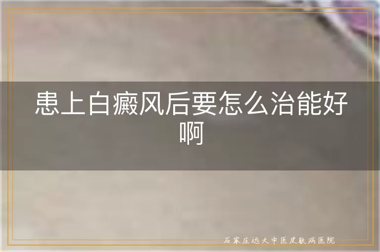 患上白癜风后要怎么治能好啊