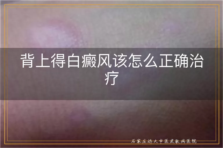 背上得白癜风该怎么正确治疗