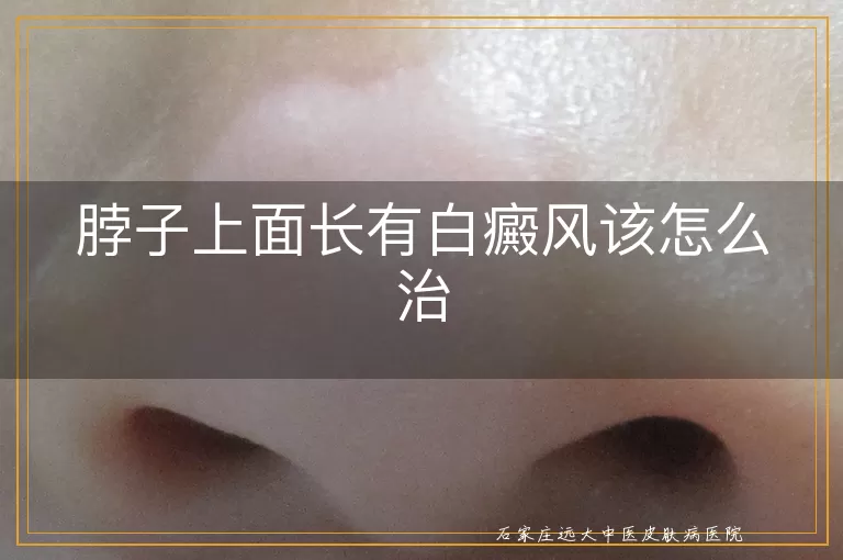 脖子上面长有白癜风该怎么治