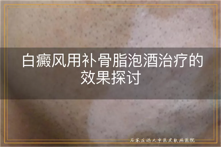 白癜风用补骨脂泡酒治疗的效果探讨