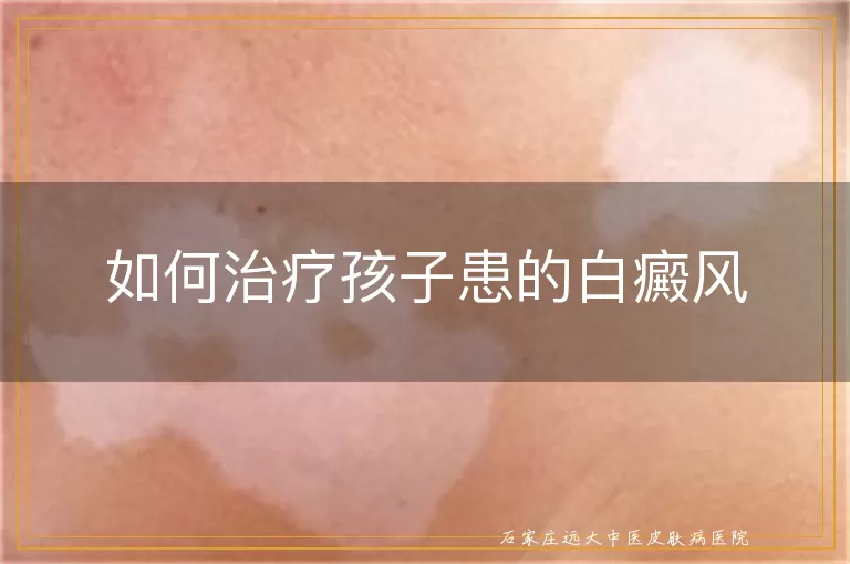 如何治疗孩子患的白癜风